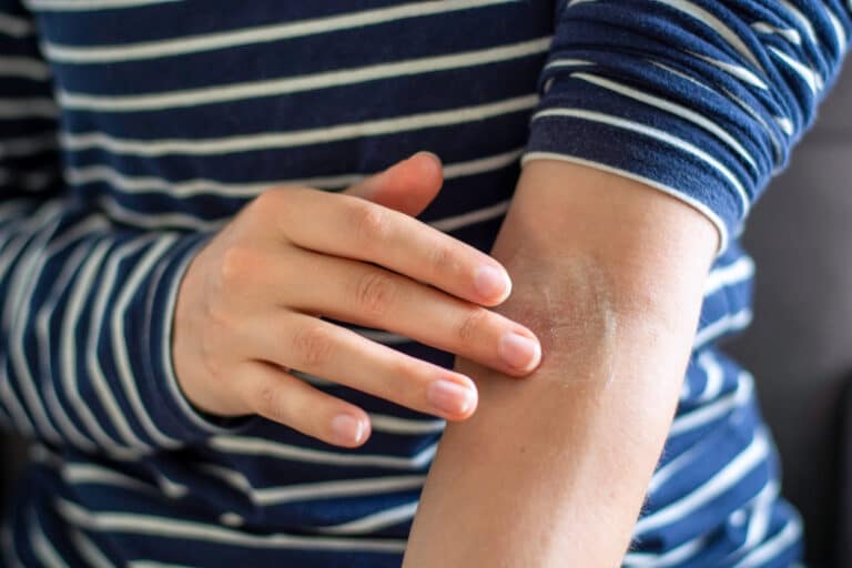 Close up of woman rubbing lotion into her arm. She wears a blue and white striped shirt with one sleeve rolled up.